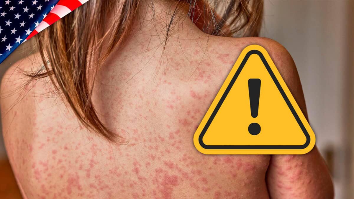 Aumentan las Alertas por Crecientes Contagios con Sarampión en Estados Unidos
