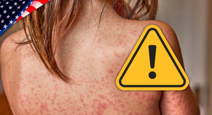 Aumentan las Alertas por Crecientes Contagios con Sarampión en Estados Unidos