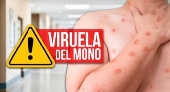 El Mundo en Alerta por Viruela del Mono: Ya se Reportan Casos en Europa y Asia