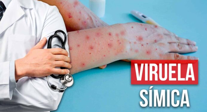 ¿Hay Viruela Símica en Cuba? Esto Dice el Ministerio de Salud Pública
