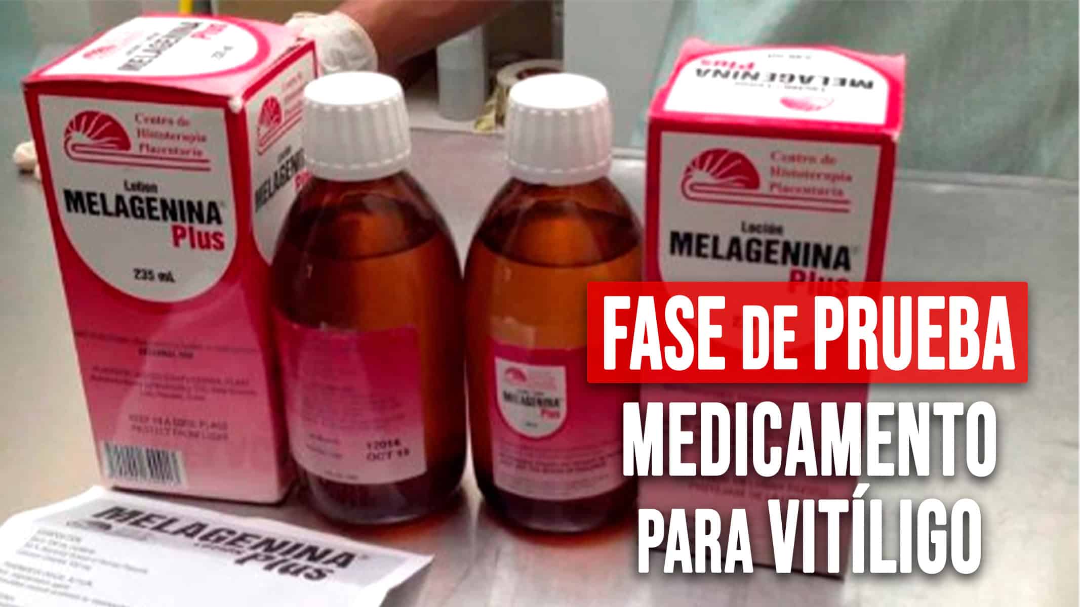 Medicamento Cubano para el Vitíligo se Encuentra en Fase de Prueba