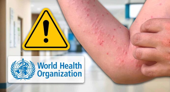 Emergencia Internacional: OMS Alerta Sobre Brote de Viruela del Mono
