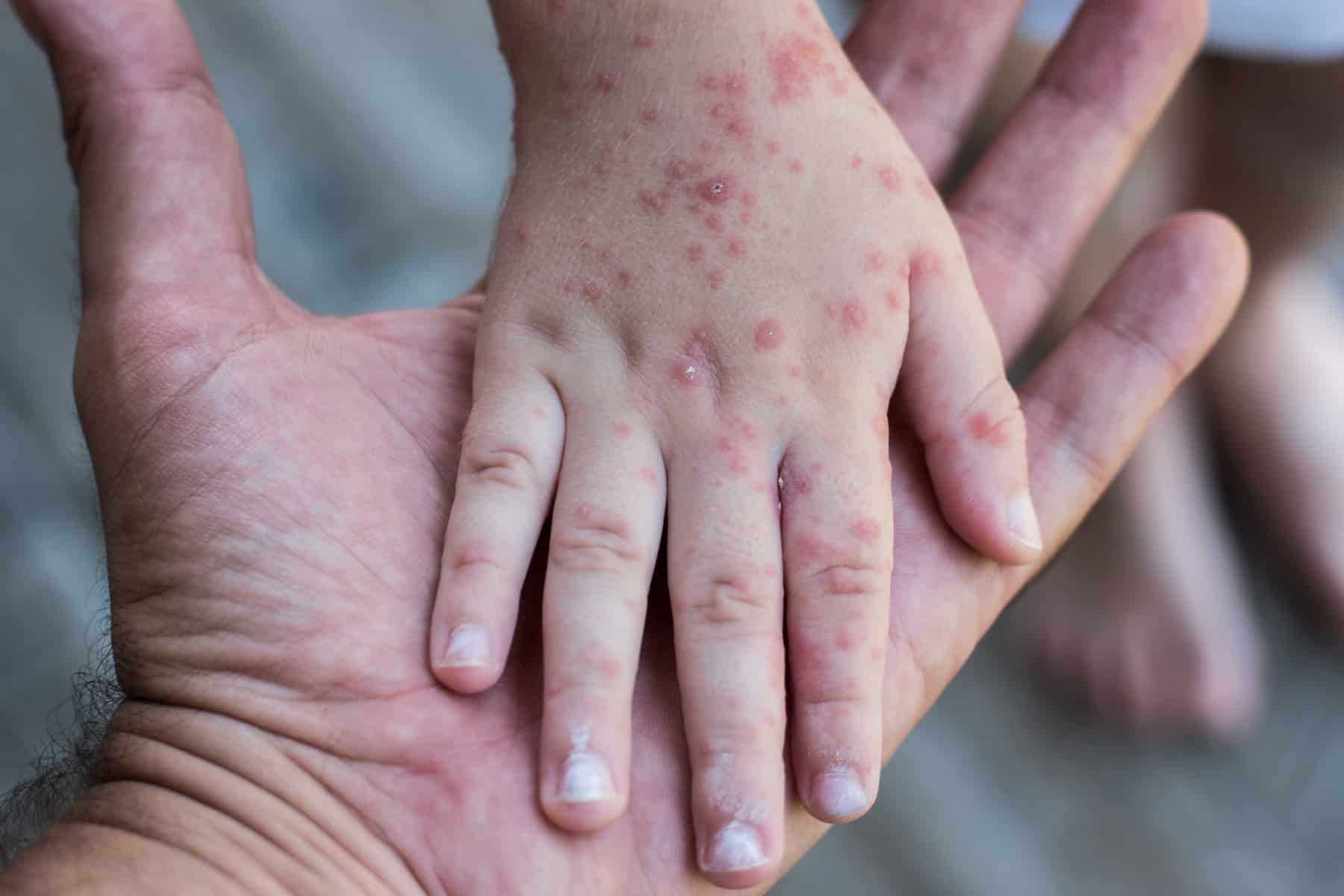 enfermedad contagiosa boca mano pie en cuba